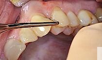 Abb. 1: Ausgangsbefund bei Erstvorstellung – klinischer Sondierungswert 10 mm mit Pus-Entleerung an Zahn 23 distal.