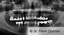 Abb. 1: Die röntgenologische Ausgangssituation vor Extraktion des beherdeten
Zahnes 14.