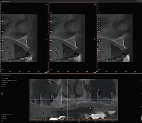 Abb. 2: Die präoperative Diagnostik mittels DVT zeigt im Frontzahnbereich einen schmalen Kiefer und im Seitenzahnbereich eine stark pneumatisierte Kieferhöhle.
