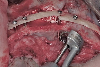 Abb. 8: Rekonstruktion des Kieferkamms mittels BBA Concept (Biological Bone Augmentation), palatinal wird eine überstehende Schraube mit Hilfe der MicroSaw gekürzt.
