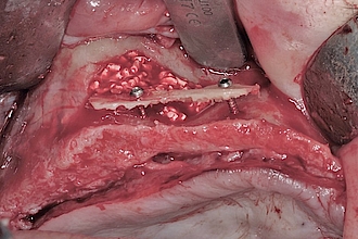 Abb. 12: Auffüllen mit Knochenersatzmaterial und laterale Augmentation auf der rechten Seite. Fixierung der Knochenschalen mittels durchmesserreduzierten Osteosyntheseschrauben.