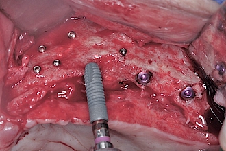 Abb. 15: In den neu aufgebauten Knochen können sechs Astratech Implantate (Dentsply Sirona) inseriert werden.