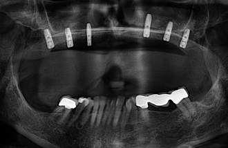 Abb. 18: Das postoperative Röntgenbild zeigt die sechs inserierten Implantate im Oberkiefer.