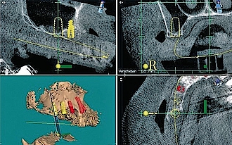 Abb. 2: Die dreidimensionale Darstellung des Sinus im DVT mit Simulation der geplanten Implantate.