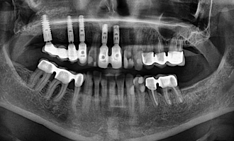 Abb. 5: Horizontaler Knochenabbau drei Jahre nach Fertigstellung des Zahnersatzes.