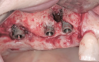 Abb. 7: Die nicht-erhaltungswürdigen Implantate im Oberkiefer links.