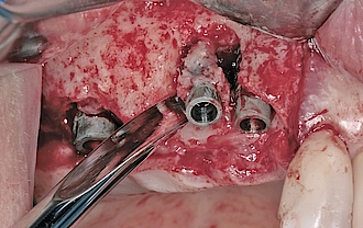 Abb. 8: Die Explantation der nicht-erhaltungswürdigen Implantate.