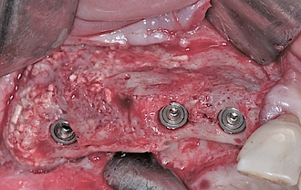 Abb. 15: Zeit nach leicht subkrestaler Insertion der Implantate in das Augmentat.