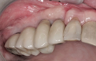 Abb. 19: Der fertige Zahnersatz eingegliedert.