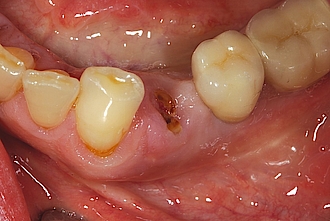 Abb. 1: Ausgangssituation mit tief frakturiertem Zahn 34.