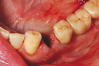 Abb. 3: Extraktionsalveole des Zahnes 34.