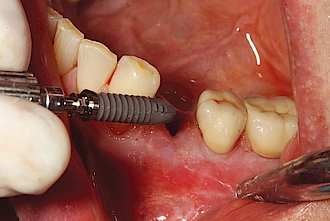 Abb. 4: Einbringen des Thommen INICELL Implantates nach Aufbereitung des Implantatstollens.