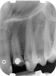 Abb. 10: Nicht erhaltungswürdiger Zahn 22 (klinisch mit Längsfraktur der Wurzel).