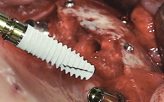 Abb. 12: Insertion des Implantats.