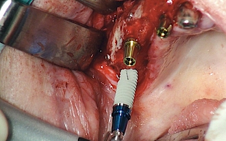 Abb. 14: Insertion der weiteren Implantate im augmentierten Gebiet.