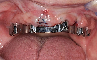 Abb. 22: Steganprobe – Zähne 11 und 23 extrahiert.